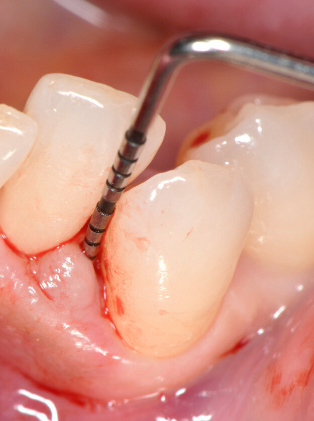 Fig. 4 - Sondaggio parodontale. PPD di 6 mm e CAL di 7 mm per l’elemento 33.