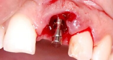 Implantacja natychmiastowa i kształtowanie estetyki różowo-białej – opis przypadku