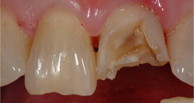 Many orofacial injuries during sports are preventable