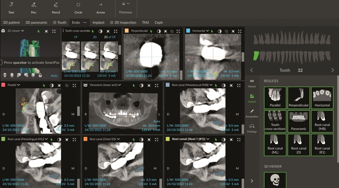 Fig. 14 : Mode endodontique de DTX Studio Clinic montrant différentes coupes de la région concernée, ainsi que la relation entre les canaux radiculaires de la molaire et le canal mandibulaire, tracées par le logiciel.