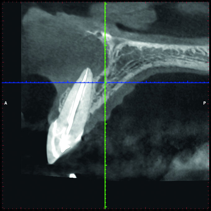 Fig. 2c: Conventional radiograph of an endodontically treated tooth #11 and cold-sensitive tooth #12 compared with CBCT imaging showing the presence of a large apical bone defect (taken at a two-day interval).