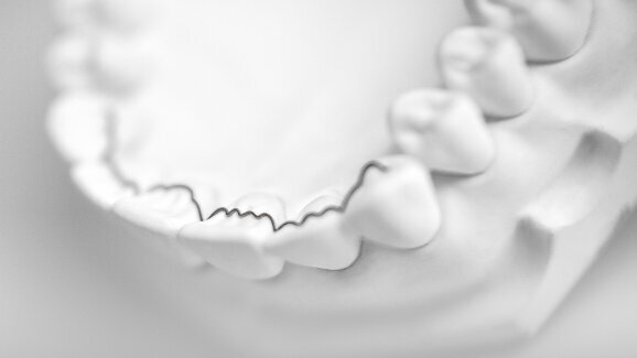 CAD/CAM-fabricated lingual retainers made of nitinol