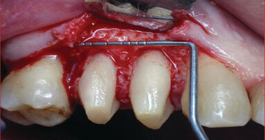 Er:YAG Garnet in laser-assisted crown lengthening