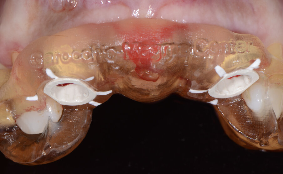 Fig. 23- Posizionamento della dima.