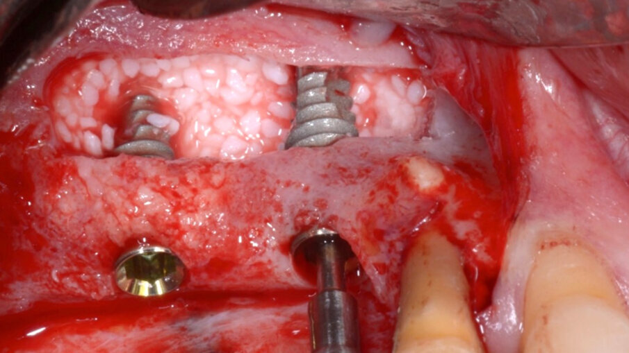 Obr. 15: Zavádění implantátů.