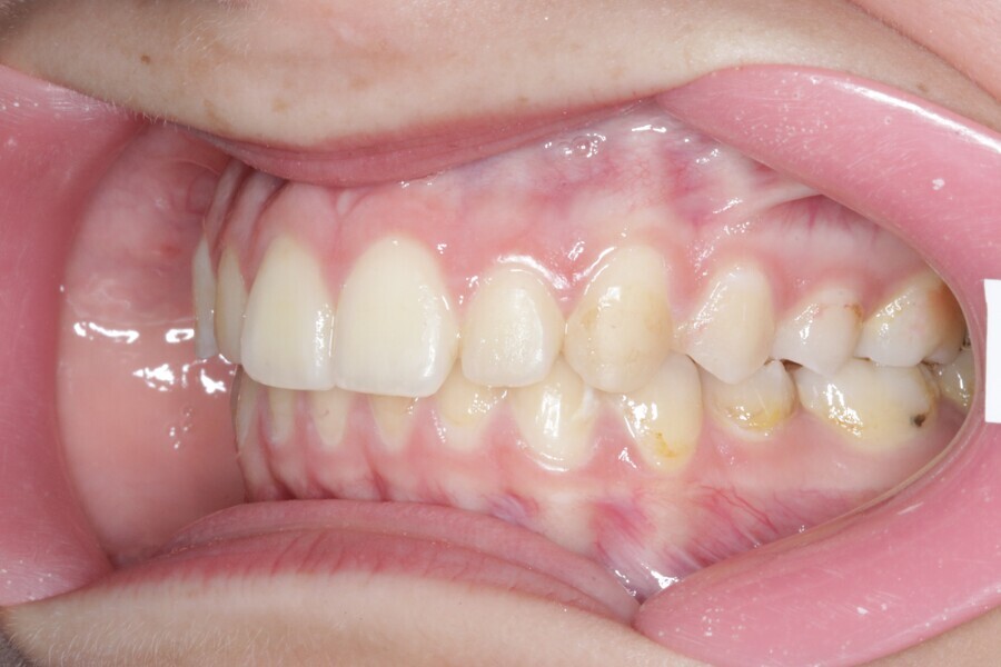 Fig. 22: Final situation after 25 Reveal aligners.