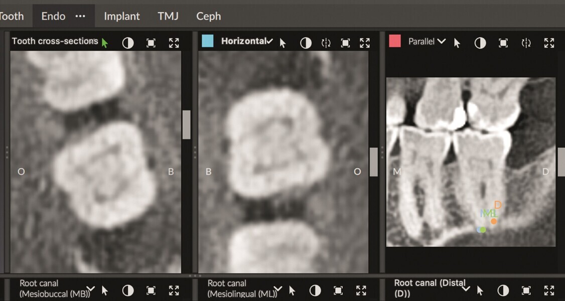 Fig. 10 : Vue horizontale d’une épaisseur de seulement 0,5 mm montrant un système complexe de canaux latéraux dans la partie coronaire du canal distal. 