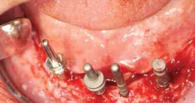 Leczenie implantoprotetyczne atroficznej żuchwy