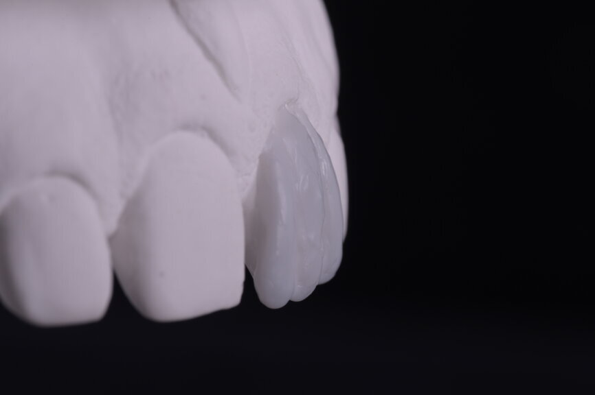 Fig. 21: First wax-up unit, lateral view.