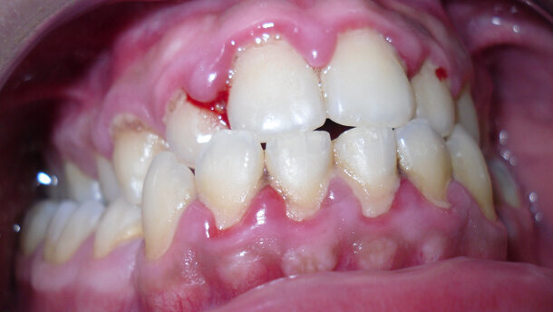 Valutazione clinica  degli effetti del prodotto a base di aminoacidi combinato con sodio jaluronato (aminogam) in pazienti sottoposti a igiene orale professionale