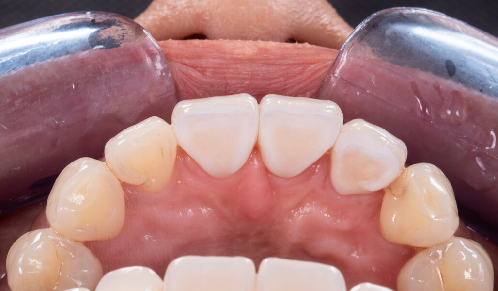 Fig. 6: Try-in of the crowns to assess the fit and the shade match.