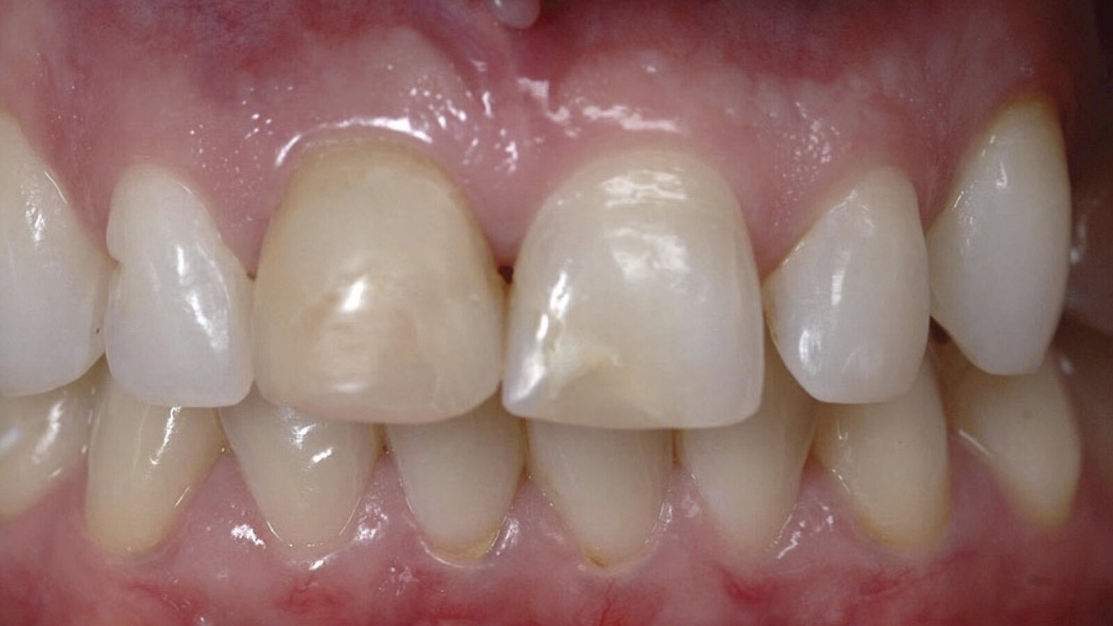 Estética y blanqueamiento dental en la era digital  (Capítulo 17)