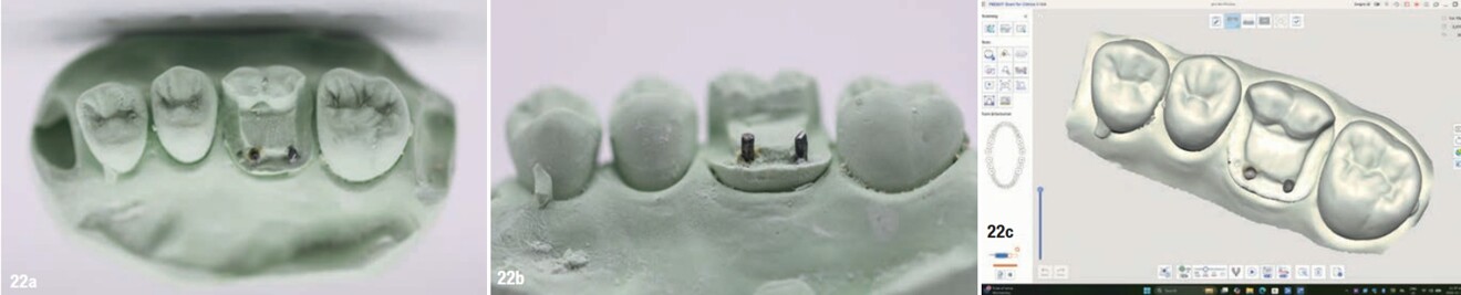 Figs. 22a–c: Cast-based pinlay preparation on tooth #26 with two dentine pins, shown in the occlusal (a) and lingual views (b), and the corresponding digitised model of the cast (c).