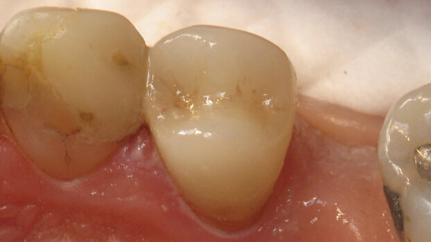 Crown cementation facilitated with the Triodent Griptab restoration handling aid