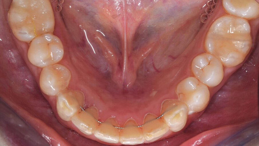 Figg. 11a, 11b_Foto contenzione con retainer e mascherina rigida.