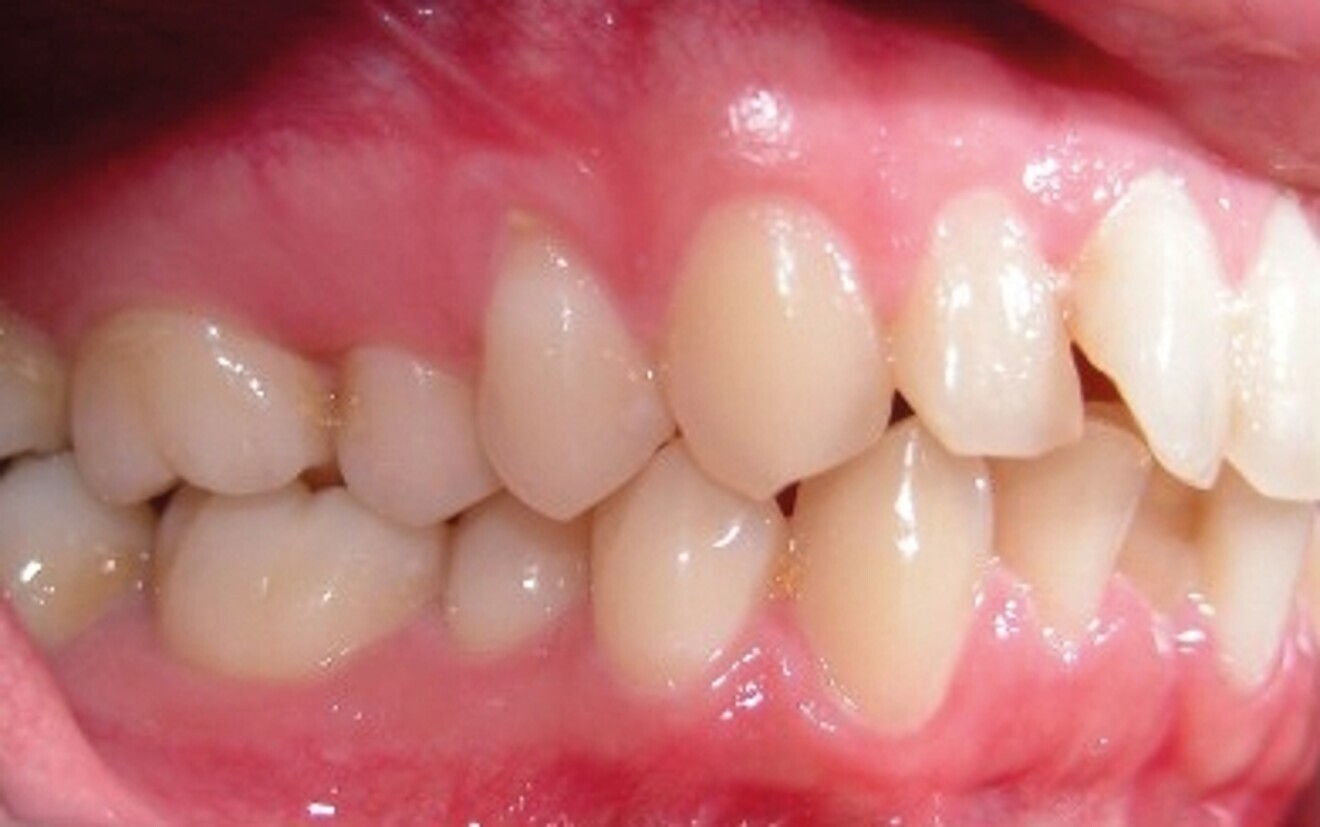 Fig. 1d : Photographie intraorale initiale.