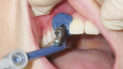 Predictable implant impressions