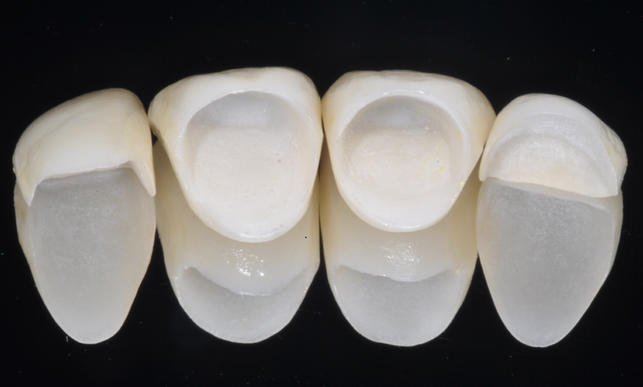 Fig. 13 - Il manufatto protesico ultimato pre cementazione.