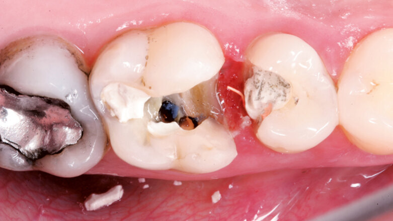 Indikační šíře MTA: Soubor kazuistik