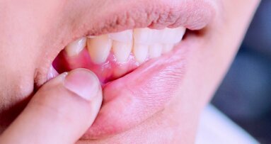 Un nuovo studio spiega il legame tra obesità e malattia parodontale