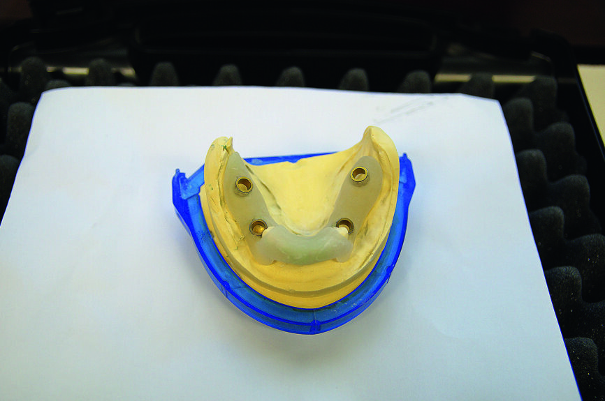Fig. 5 : Gabarit de forage totalement « navigué » pour la mandibule après planification CBCT. 