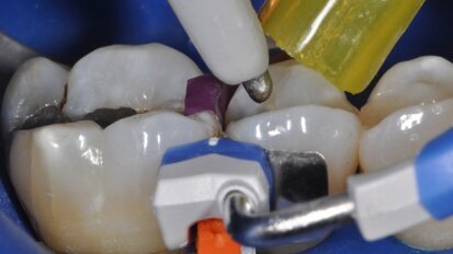 Restauro interprossimale diretto di un elemento 1.5 con il sistema Composi-Tight 3D Fusion™