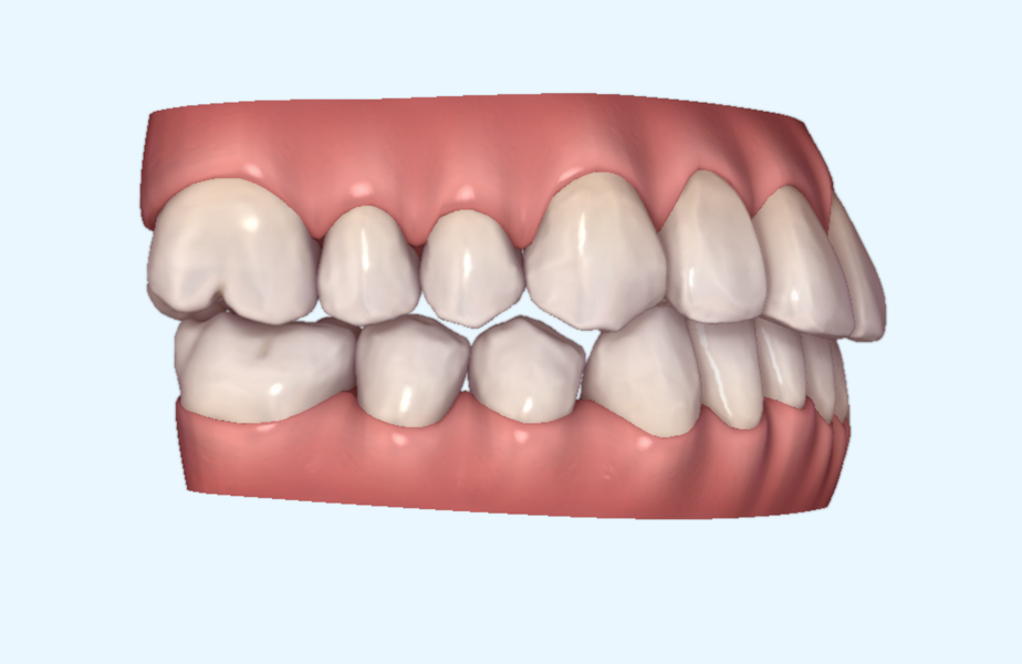 Figs. 21a & b: Invisalign ClinCheck refinement treatment plan before and after lateral views