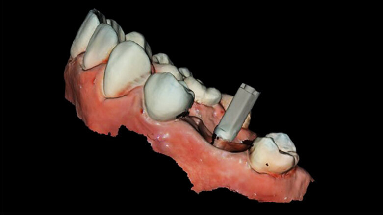 Digitální workflow a aplikace PRF a ozonové terapie v orální rehabilitaci