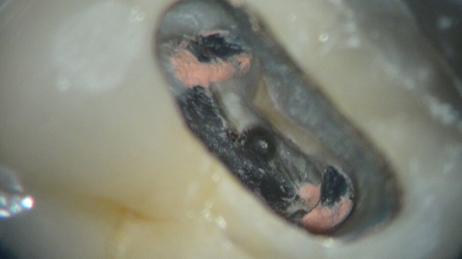 Afbeelding 11. Het gevaar op een perforatie wordt te groot. 