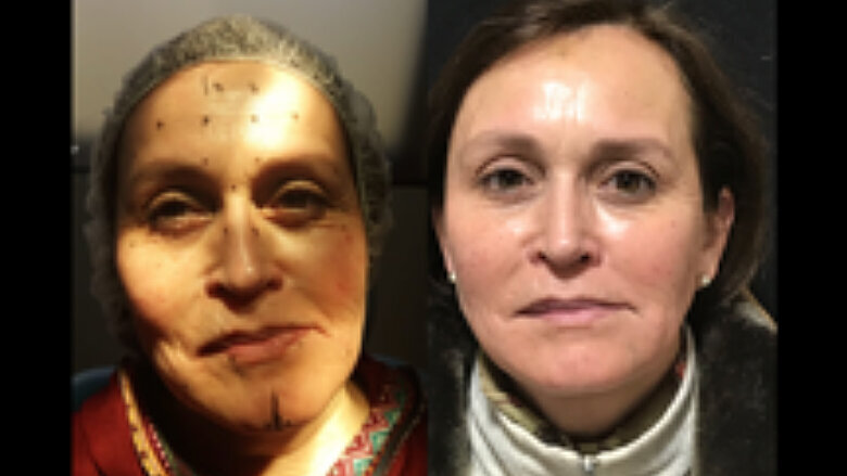 Foto 4. Control de aplicación de rellenos y toxina a las 48 hrs. Es evidente la mejora del aspecto general gracias al tratamiento con toxina botulínica (Dysport). Nótese volúmenes genianos y zona perilabial.
