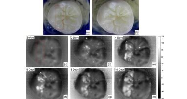 Ново нискобюджетно устройство може да спомогне ранното откриване на зъбен кариес