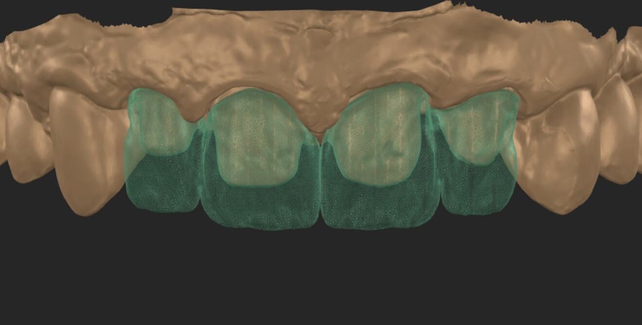 Fig. 1: CAD of the zirconia frameworks. Splinted crowns rendered in a transparent view to show the abutment teeth.