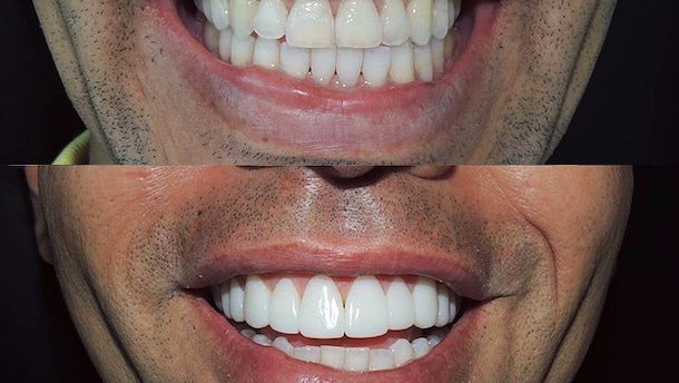 ¿Existe realmente el Diseño de la Sonrisa?