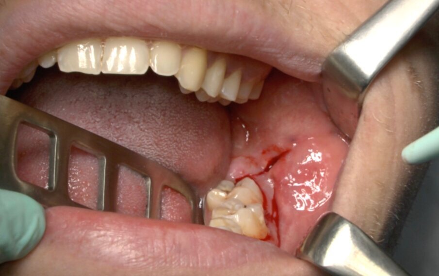 Fig. 3_Disegno del lembo triangolare.