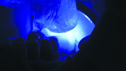 3M™ RelyX™ Ultimate Adhesive Resin  Cement – Posterior Crown