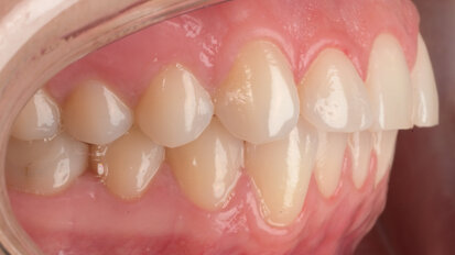 Infra-zygomatic crest screws for absolute anchorage in maxillary distalisation: A focus on aligner treatment optimisation