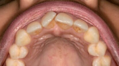 Inman Aligner - Efikasno sredstvo u minimalno invazivnoj „kozmetičkoj” stomatologiji (Prvi deo)