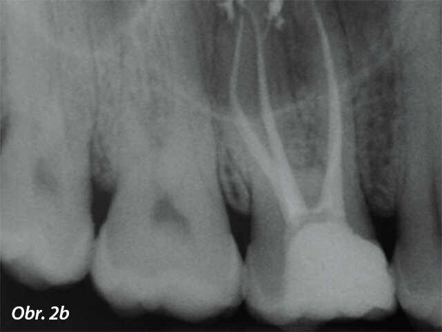 Úspěšná terapie je, když jsou plnicí materiály schopny pevně utěsnit prostor kořenových kanálků, a to i v případě více výstupů