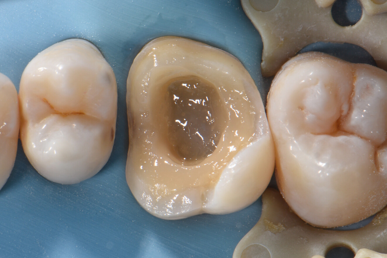 Fig. 22b: Subsequent layering with the same resin-based composite.