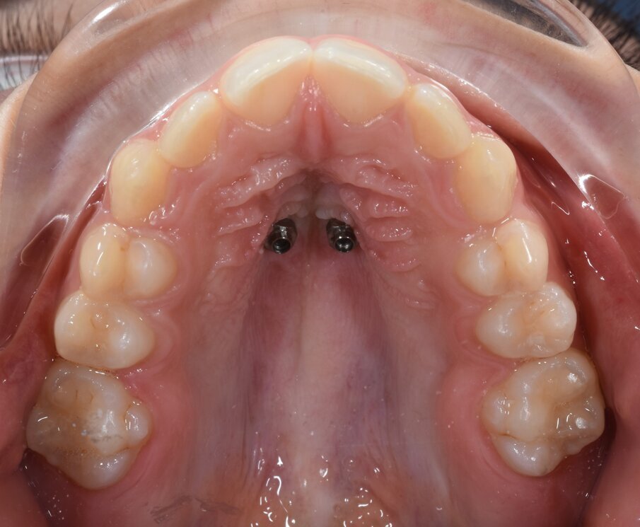 Fig. 5a_Inserimento miniviti. 