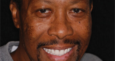 Life-saving treatment includes complete maxillary and mandibular dentures