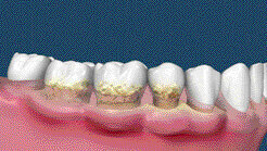 Les cancers de la tête et du cou peuvent résulter d’une parodontite