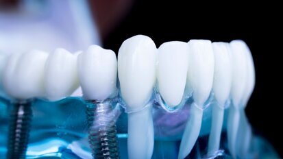 Bones and machines: AI and the transformation of dental implantology