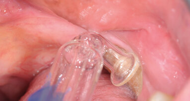 Ozonoterapia nel trattamento delle osteonecrosi mascellari