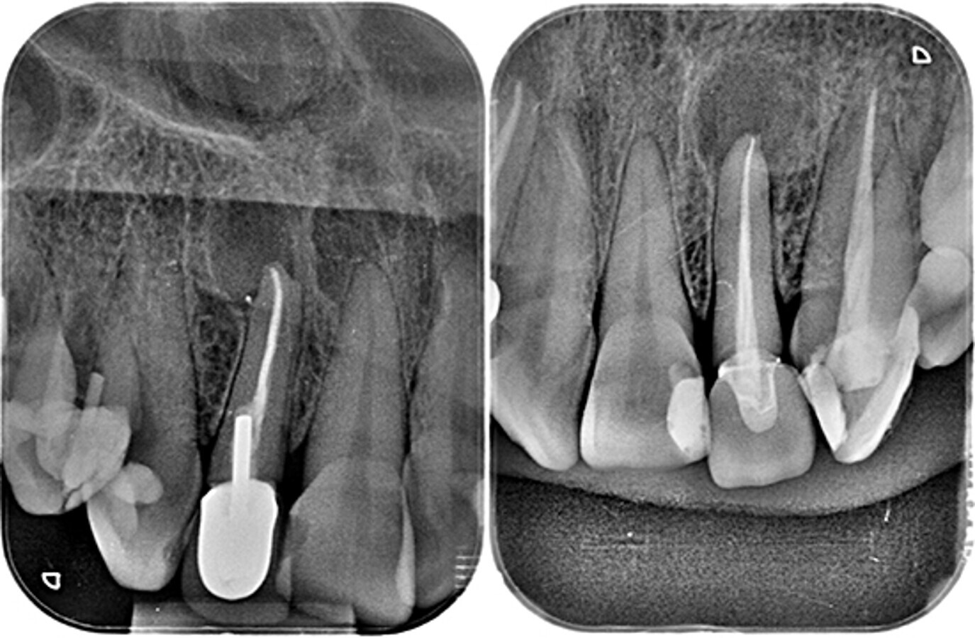 Figuras 2 y 3. RadiografÃ­as periapicales del 1.2 y 2.2 donde se aprecian las lesiones apicales.