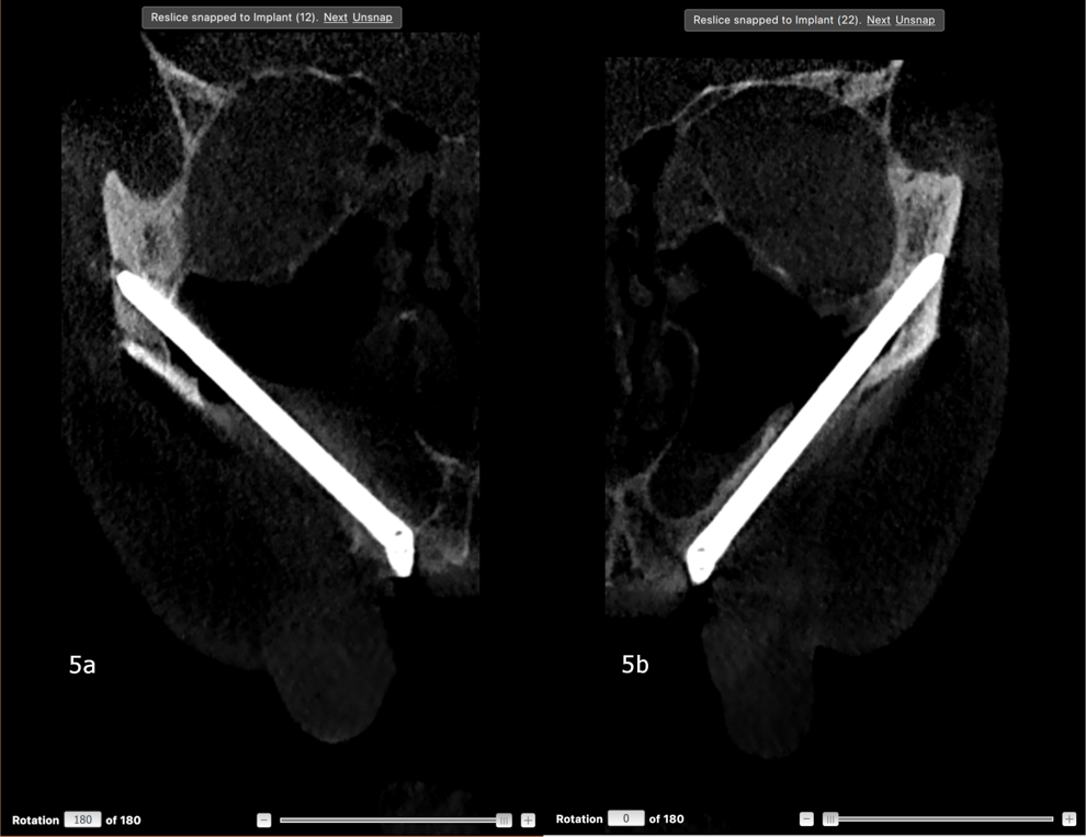 Figs. 5a & b: Postoperative CBCT slices showing the zygomatic implants emerging at sites #12 (a) and 22 (b).
