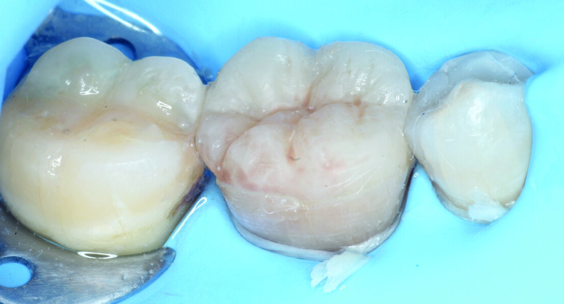 Fig. 15a: Light polymerisation after removal of the excess luting material.