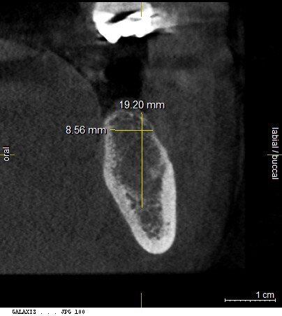 Fig. 2: CBCT scan measurements demonstrate availability of bone of adequate height and width.