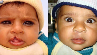 Chinese Doctors to Perform Free Cleft Lip and Palate Operations