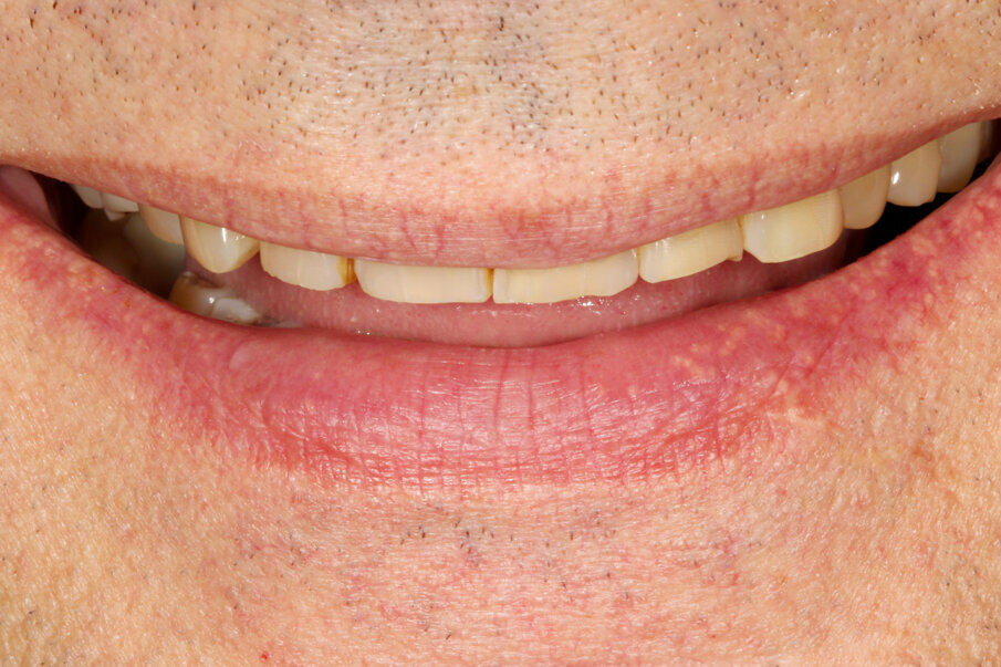 Fig. 1: Pronounced abrasion due to bruxism, resulting in significant loss of the vertical dimension.